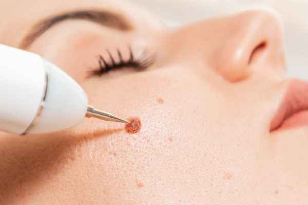 CryoPen: 5 Skin Concerns It May Be Used to Treat 3 What actually happens during a CryoPen treatment Colchester?