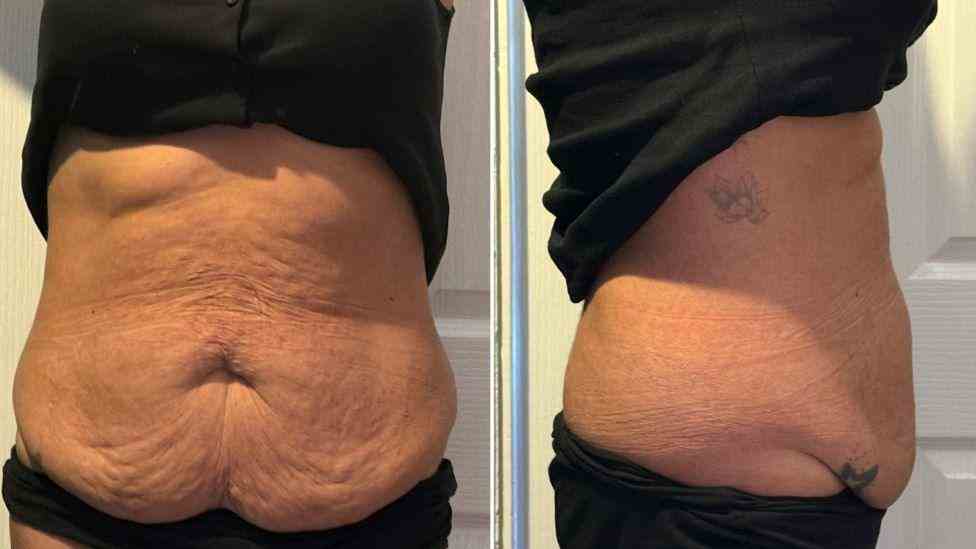 Lost the Weight but Not the Loose Skin? What You Should Know 1 Is It Definitely Loose Skin Colchester?